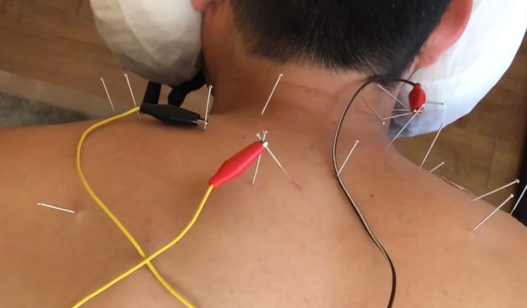 Dry needling treatment on foot at PT of City, physiotherapist in Islamabad